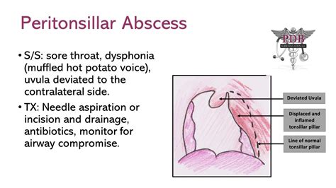Peritonsillar Abscess Emergency Nursing Medical Radiography Nursing