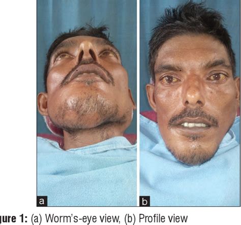 Figure 1 From A Rare Case Of Mucoepidermoid Carcinoma Of Parotid With Mandibular Metastasis