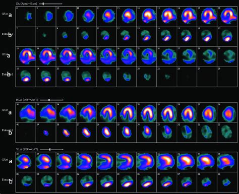 A Myocardial Perfusion Imaging Using Tc M Mibi Spect At Rest In A