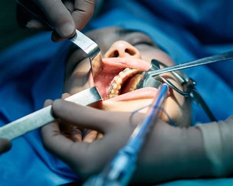 10 Perawatan Pasca Operasi Gigi Bungsu Klinik Gigi SATU Dental