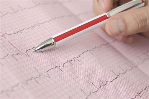 Atrial Fibrillation Classification Symptoms Causes And Treatment