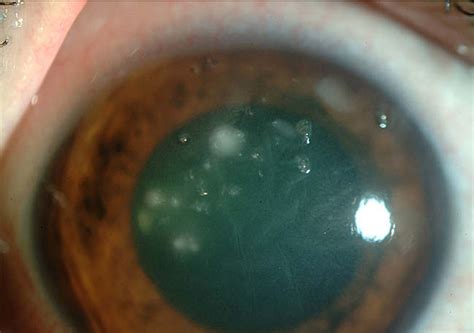 Figure 1 From Microbial Keratitis After Corneal Collagen Crosslinking