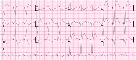 Dr. Smith's ECG Blog: Patient with Paced Rhythm in Severe Cardiomyopathy Presents with SOB due ...