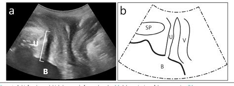 Figure 1 From The Role Of Gel Infused Translabial Ultrasound As A New