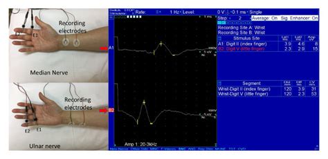 Measurement Of The Conduction In The Sensory Median And Ulnar Nerve