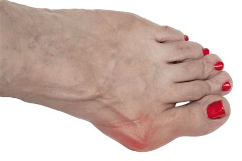 What Is The Difference Between Gout Vs Bunion