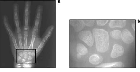 Figure 1 From X Ray Carpal Bone Image Boundary Feature Analysis Using