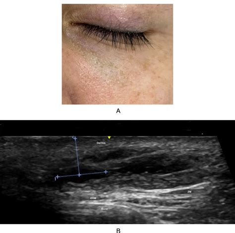 Ultrasonographic Features Of Non Vascular Complications Of Hyaluronic Acid Fillers A