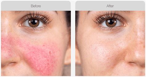 Ipl For Rosacea • Photorejuvenation • Nascent Skin And Beauty