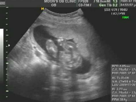 20 Week Sonogram YouTube