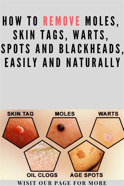 How To Remove Moles Skin Tags Warts Spots And Blackheads Easily And Naturally Mole Removal