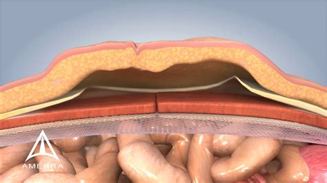 Ventral Hernia Pictures Laparoscopic Ventral Hernia Repair With