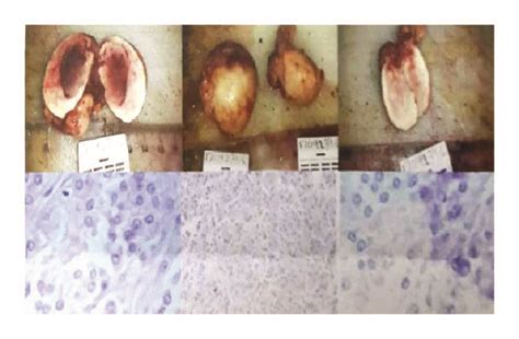 Upper Left Shows Leydig Cell Tumor Of The Right Ovary Upper Right