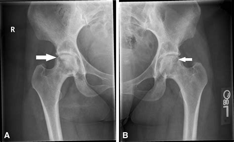 Avascular Necrosis Of The Hip Journal Of Emergency Medicine