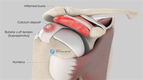 Arthroscopic Removal Of Rotator Cuff Calcium Deposits Doctor Matthieu