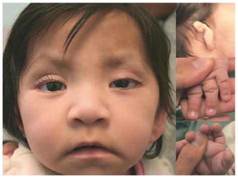 Left Patient At 9 Months Of Age With Typical Dysmorphic Features Download Scientific Diagram