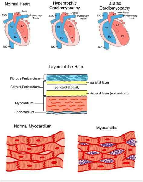 Normal Myocardium Versus Myocarditis Svc Superior Vena Cava Ivc