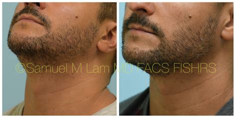 Minoxidil Before And After Beard