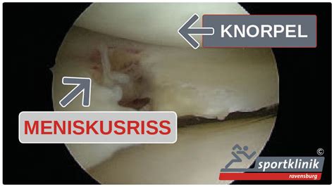 Meniskusriss Meniskusschaden Ursachen Symptome Behandlung