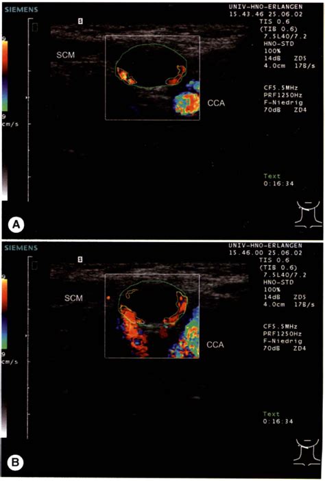 Figure 2 From Metastatic And Inflammatory Cervical Lymph Nodes As