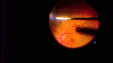 Vitrectomy For Vitreous Opacification Fov Youtube