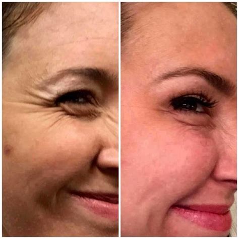 Botox Crows Feet Before And After