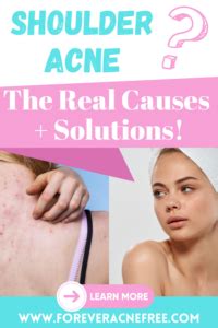 Shoulder Acne: Uncovering the Real Causes and Solutions - Forever Acne Free