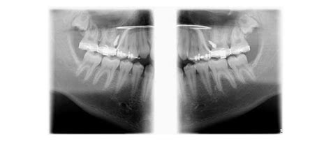 Temporary Anchorage Device Tad Use In The Treatment Of Anterior Open