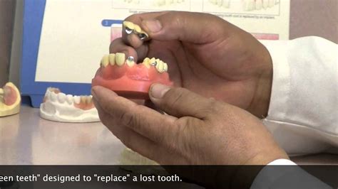 Types Of Dental Bridges Huntington Beach Corona Ca Dental Clinic