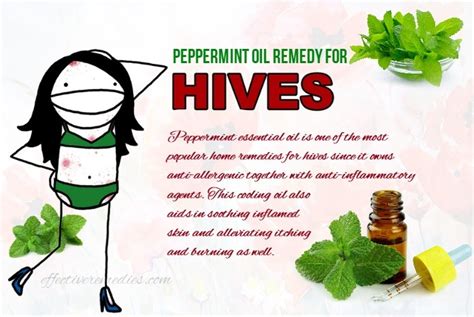 17 Best Natural Home Remedies For Hives