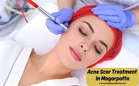 Unlocking Radiant Skin The Best Acne Scar Treatment In Magarpatta By