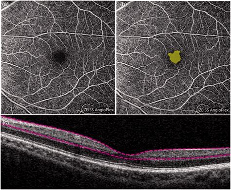 Optical Coherence Tomography Angiography OCTA Images Of Superficial