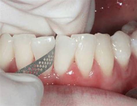 What Is Interproximal Reduction Ipr In Orthodontics Archwired