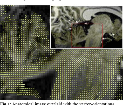 Figure 1 From Isotropic High Resolution Diffusion Tensor Imaging In