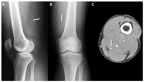 Cancers Free Full Text Synovial Sarcoma In The Extremity Diversity