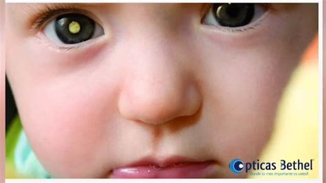 Retinoblastoma Conocé Las Causas Y Síntomas De Esta Enfermedad Youtube