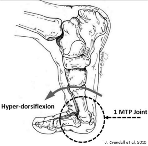 Avoiding Metatarsal Phalangeal Joint Pain When Forefoot Running - RUN FOREFOOT