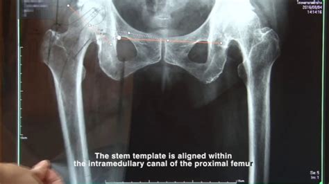 Templating Total Hip Arthroplasty On Pacs Digital X Ray Youtube