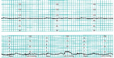 Electronic Fetal Monitoring Flashcards Quizlet