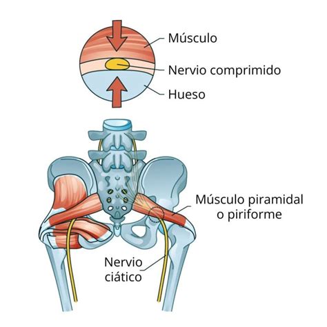 El S Ndrome Piramidal O Falsa Ci Tica Fisioterapia Sevilla Hve