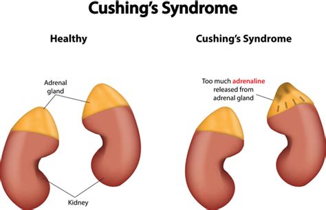 Cushing Disease Medlineplus Genetics