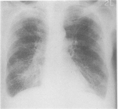 Posteroanterior Chest Radiograph Showing Bilateral Widespread