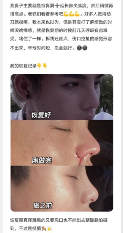 Yin Shihang Showed His Plastic Surgery Process Generously After Seeing