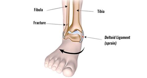 Medial Ankle Sprain Motus Physical Therapy