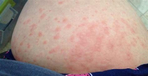 Skin Rash During Pregnancy Pictures Photos