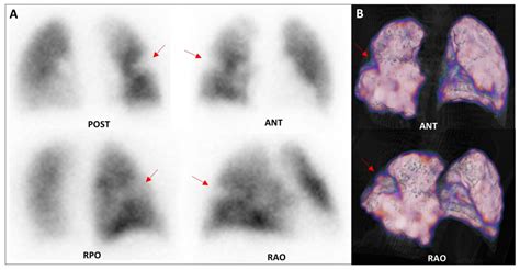 Healthcare And Economic Impact Of Lung Perfusion Scintigraphy In