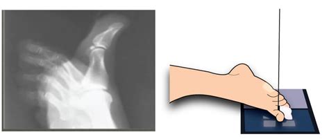 X-Ray Positioning Guide: Toes | Medical Professionals