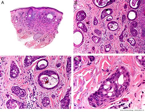 Treatment Of Malignant Cutaneous Adnexal Neoplasms Actas Dermo