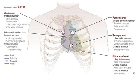 Aortic Regurgitation Murmur