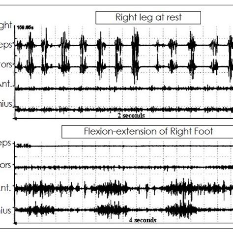 Tremorogram from the right hand of a patient with psychogenic tremor of ...